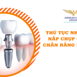 thu tuc nhap khau nan chup co dinh chan rang nhan tao